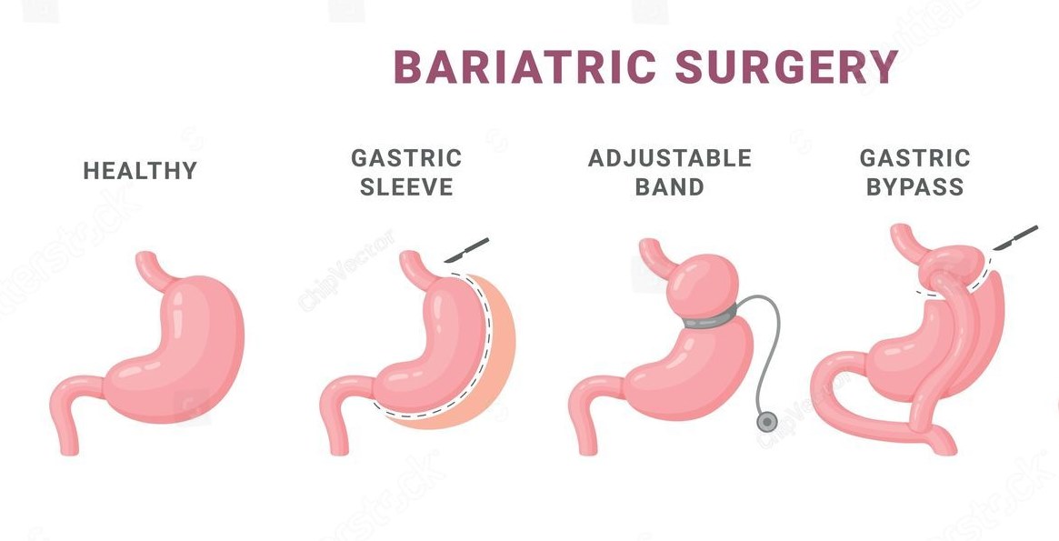 Gastric Bypass Surgery