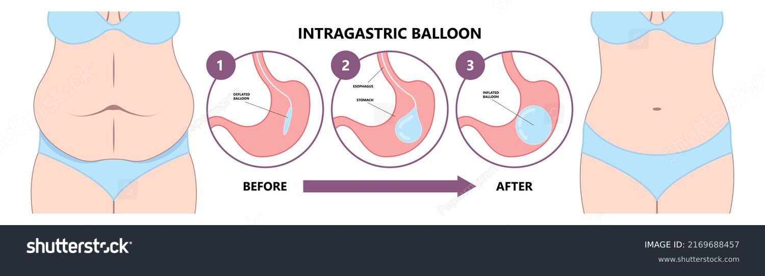 Gastric Balloon