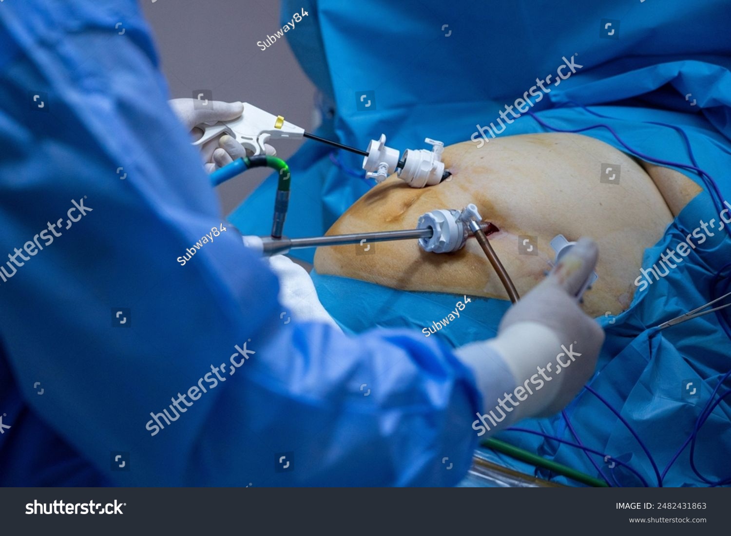 Laparoscopic Gastric Surgery